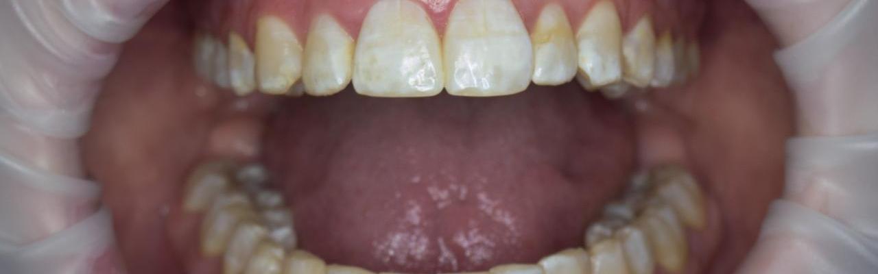 fluorose dentaria